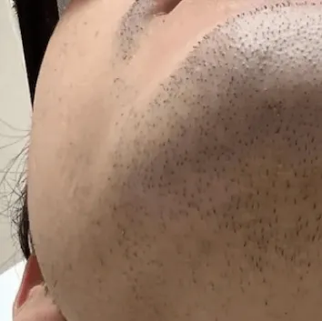 Skin before treatment